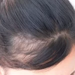 Hair loss treatment