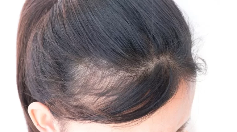 Hair loss treatment