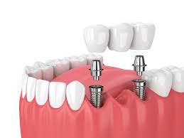 How Dental Implants Influence Taste Perception and Sensory Experience